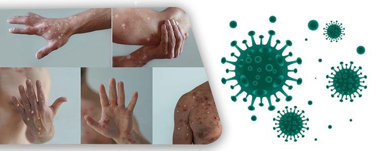 MONKEY-POX