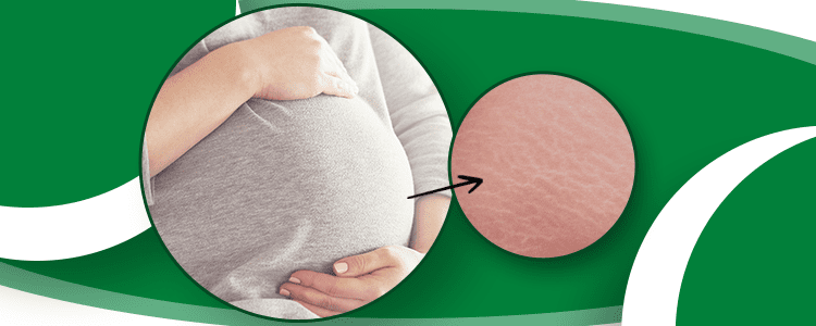 Get Rid from stretch marks post delivery