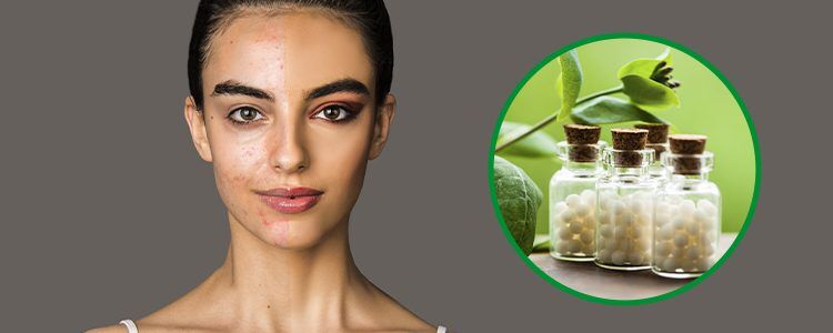 Get-Rid-of-Dark-Spots-The-Power-of-Homeopathy-for-Pigmentation-Schwabe-blog-banner