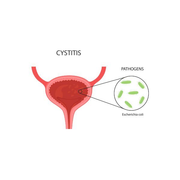 Cystitis