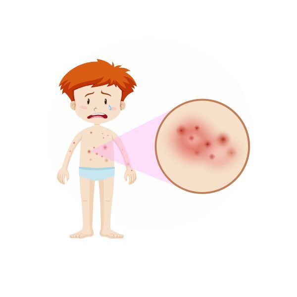 Eczema