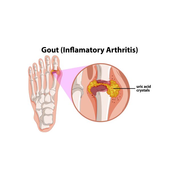 Gouty arthritis