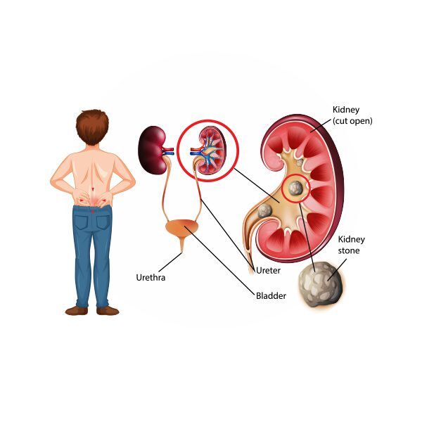 Kidney Stones