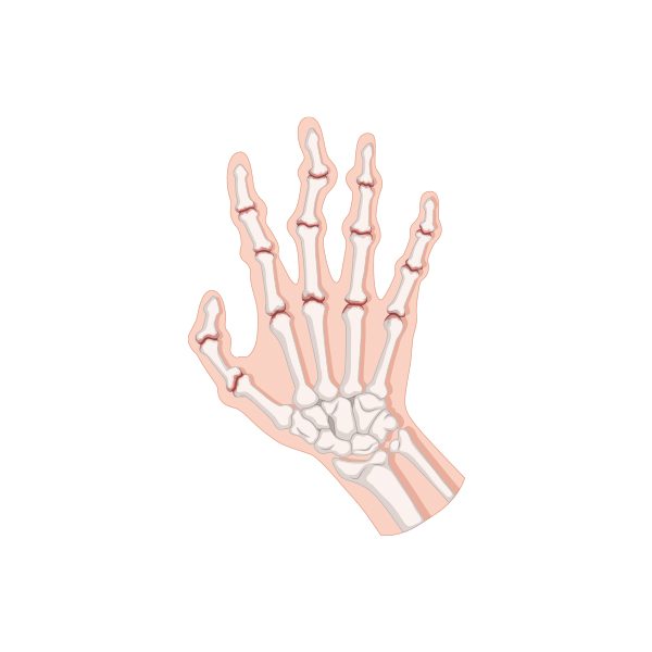 Psoriatic arthritis