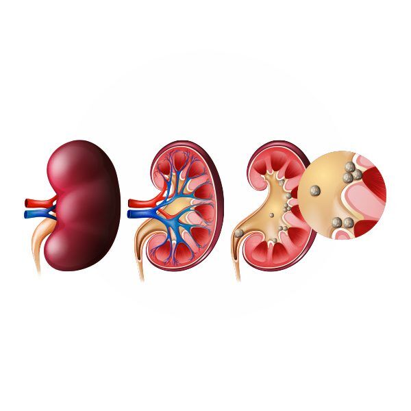 Renal stone