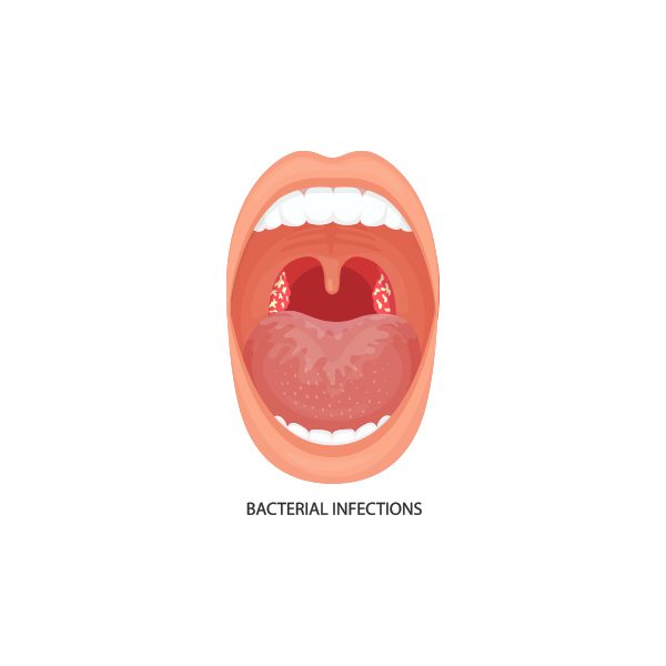 Tonsilitis