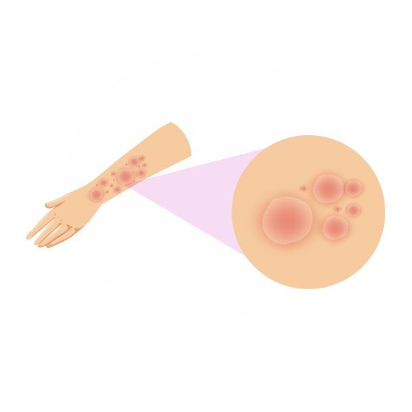 Fungal infection