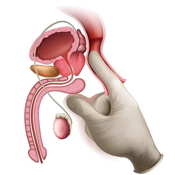 Benign Prostatic Hyperplasia