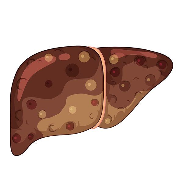 Chronic Liver Disease