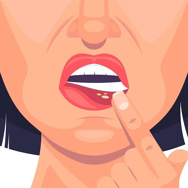 Tender gums that bleed easily