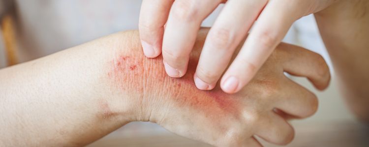 7 Best Homeopathic Remedies For Itchy and Dry Skin