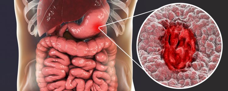 How homeopathy Soothes Stomach Ulcers