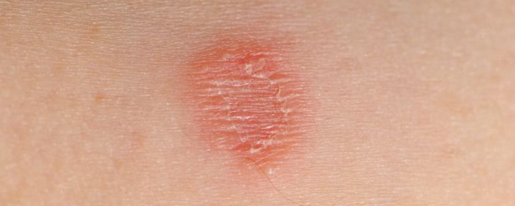 Ringworm Relief: The Ultimate Guide to Homeopathic Solutions