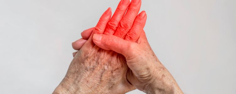 5 Key Symptoms of Rheumatoid Arthritis Flares