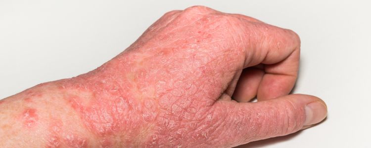 Homeopathy vs. Eczema: How Long Until You See Results?