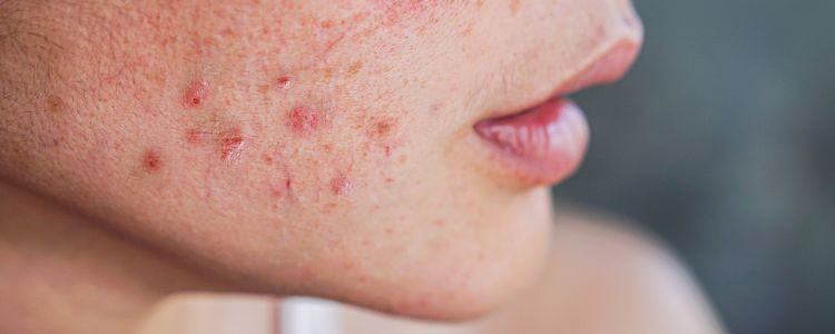What Your Face Spots Are Trying to Say