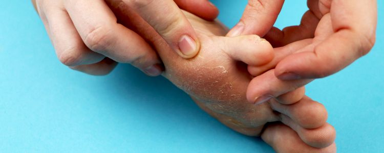 Why Fungal Infections Keep Coming Back – and How to Treat Them Effectively